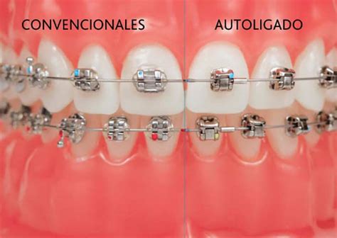 brackets autoligables esteticos o metalicos|brackets autoligables diferencias.